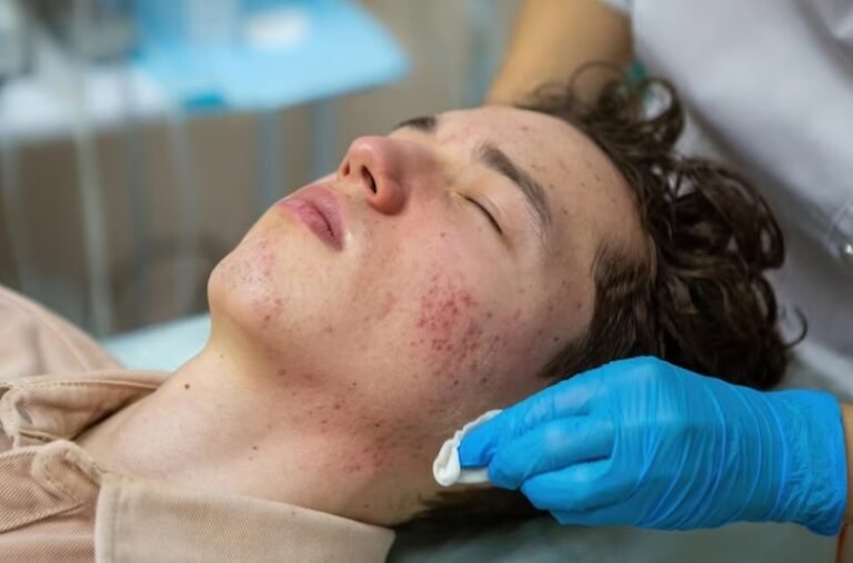 Compelling Skin break out Check Laser Treatment: Clear Skin is Fair a Treatment Absent